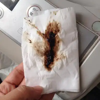 怀孕5周有褐色分泌物今天直接黑色的啦求助